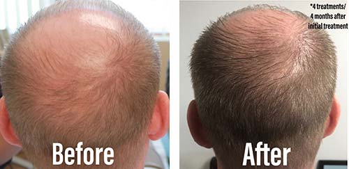 Hair Restoration Before After