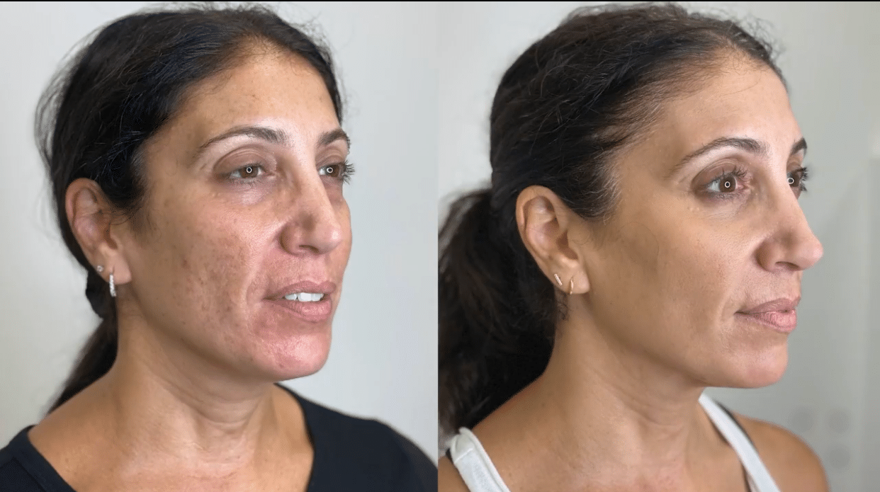 Microneedling Results