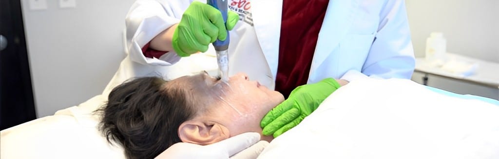 Microneedling SBC (1)