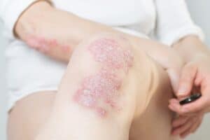 Acute psoriasis on the knees ,body and elbows