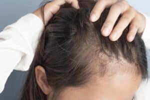 Young,Women,Stressed,And,Having,Hair,Loss,,Thinning,Hair