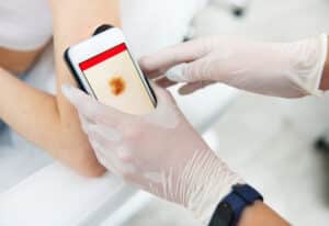 Close-up of a doctor's hand in medical gloves holding a dermoscope and examining moles on the patient's arm.