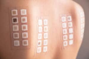 Alergy,Patch,Test,On,The,Back,Of,A,Young,Woman