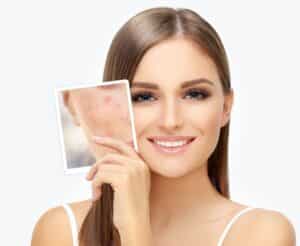 Woman with smooth, bright skin holding a photo up to show how damaged her skin was before laser skin resurfacing.