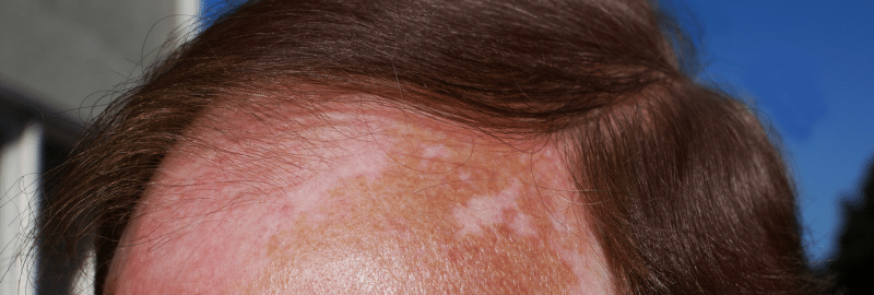 Vainder How to Protect Your Scalp and Hair from Sunburn