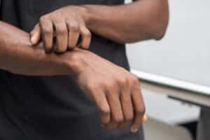 Man with dark skin scratching at eczema on his arm.
