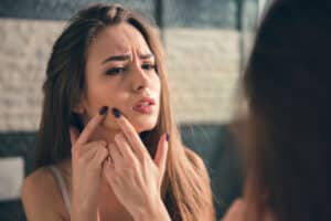 Unhappy woman looking in the mirror at postpartum acne in Los Angeles, CA