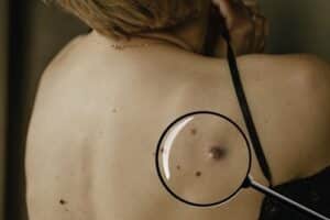 Fibroma and moles with age spots on the female back, details, close-up