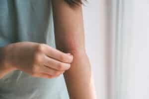 Woman touching her arm with psoriasis in Los Angeles, CA
