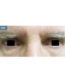 Eyelid Surgery