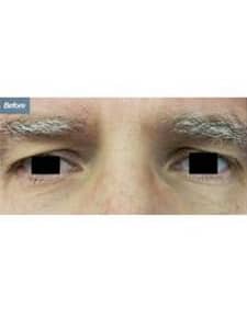 Eyelid Surgery