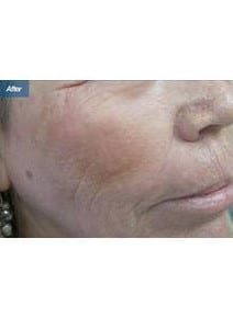 Laser Resurfacing