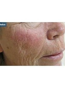 Laser Resurfacing