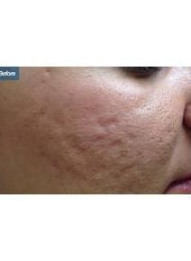 Microneedling