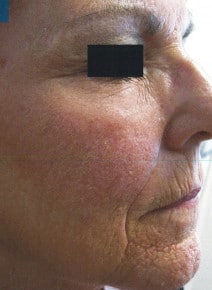 CO2 Laser Resurfacing