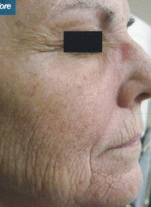 CO2 Laser Resurfacing