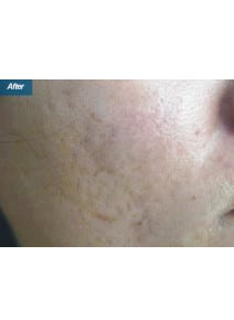 CO2 Laser Resurfacing