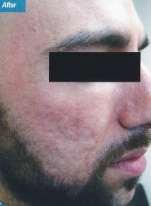 CO2 Laser Resurfacing