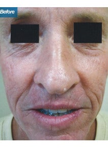 CO2 Laser Resurfacing