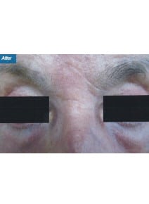 CO2 Laser Resurfacing