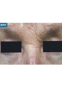 CO2 Laser Resurfacing