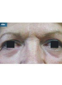 CO2 Laser Resurfacing