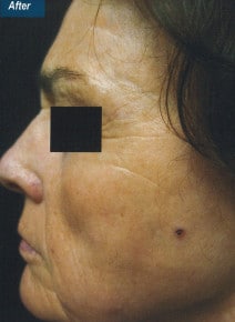 CO2 Laser Resurfacing