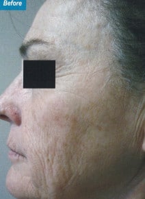 CO2 Laser Resurfacing