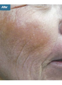 CO2 Laser Resurfacing