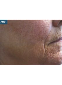 CO2 Laser Resurfacing