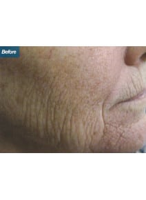 CO2 Laser Resurfacing