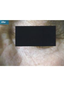 CO2 Laser Resurfacing