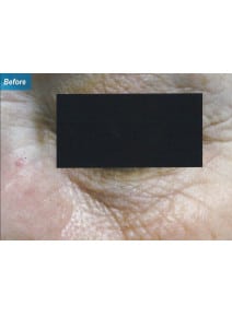 CO2 Laser Resurfacing