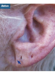 Earlobe Filler