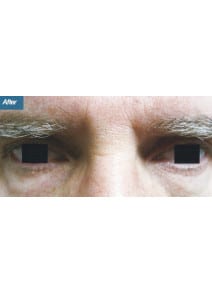 Eyelid Surgery