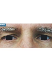 Eyelid Surgery