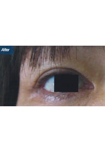 Eyelid Surgery