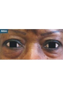 Lower Eyelid Surgery