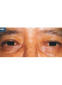 Upper and Lower Eyelid Surgery