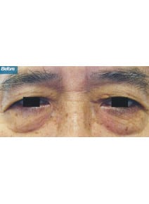 Upper and Lower Eyelid Surgery