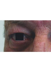 Upper Eyelid Surgery