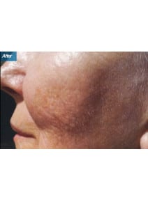 Microneedling