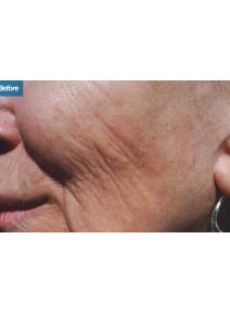 Microneedling