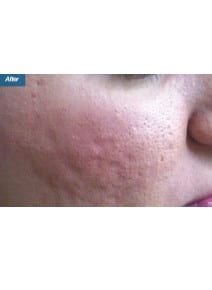 Microneedling