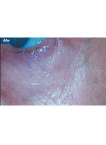 Microneedling