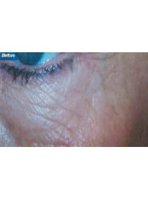 Microneedling