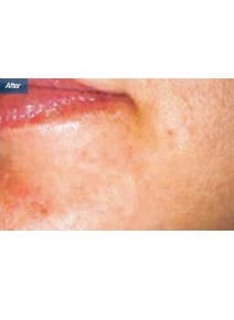 Microneedling