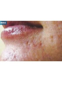 Microneedling