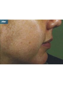 Microneedling