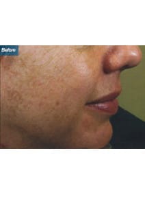 Microneedling